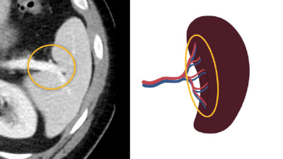 What is an Accessory Spleen? (with pictures)